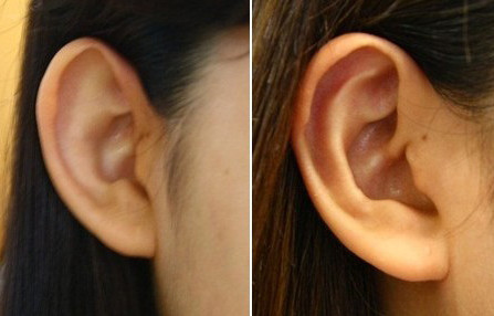 你的耳朵需求整形吗？注意4种耳朵