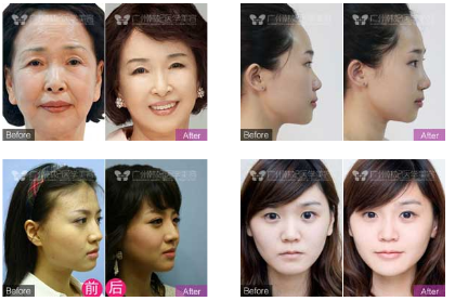 广州哪位医生做面部提升或年轻化好呢？