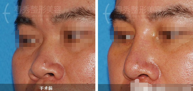 广州权威鼻修复专家排行榜 广州鼻子修复做得做好的整容医生排名