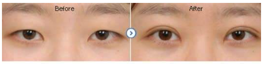 郑州割双眼皮的专家有哪些？郑州割双眼皮哪个医生性价比高？
