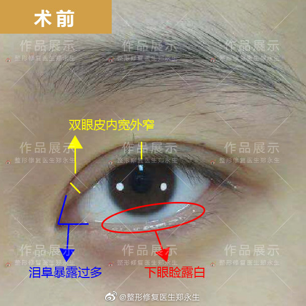 八大处靳小雷和郑永生双眼皮修复哪个厉害？