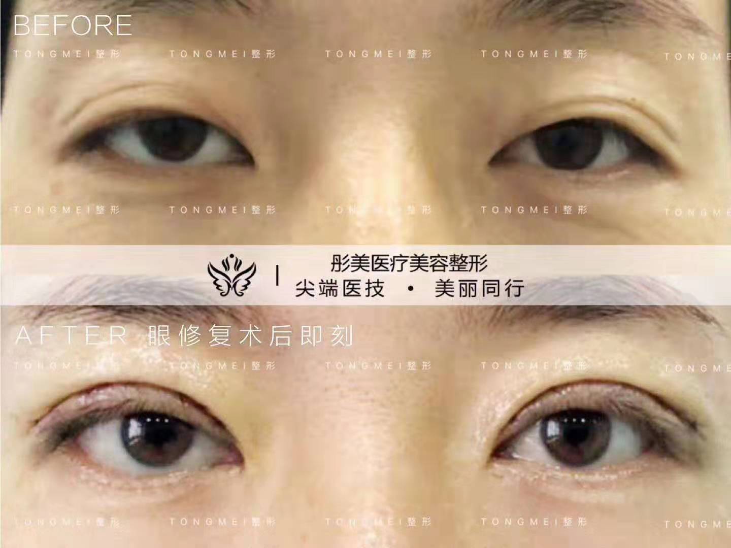 刘风卓双眼皮修复案例