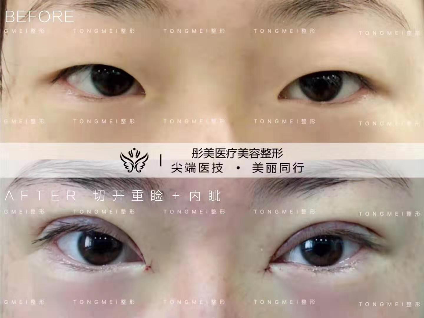 北京刘风卓割双眼皮和双眼皮修复案例效果图 刘风卓预约
