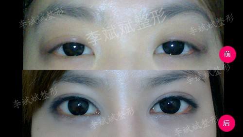 赵红艺和李斌斌哪个医生做双眼皮修复比较好？