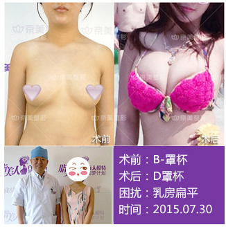 北京自体脂肪丰胸专家哪个最厉害？梁耀婵和刘成胜哪个好？