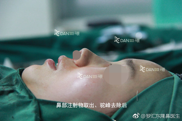 北京哪位医生擅长做鼻部注射物取出手术？鼻部微晶瓷,骨粉,奥美定取出专家