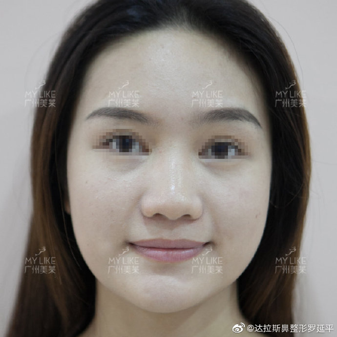 广州罗延平和欧阳春哪个隆鼻技术好？欧阳春和罗延平隆鼻&鼻修复案例预约