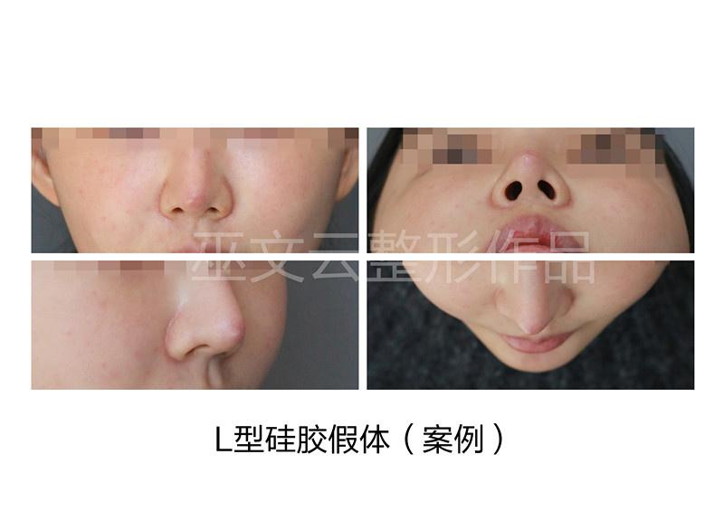 北京刘彦军和巫文云哪个鼻子&鼻修复做得好？