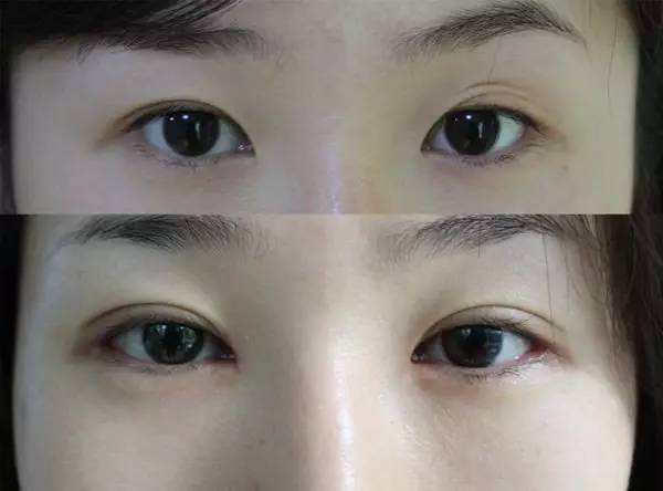 八大处靳小雷和郑永生双眼皮修复哪个厉害？