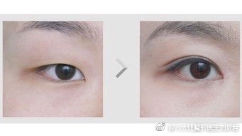 八大处双眼皮&双眼皮修复最好的专家：刘珍君（预约案例评价）