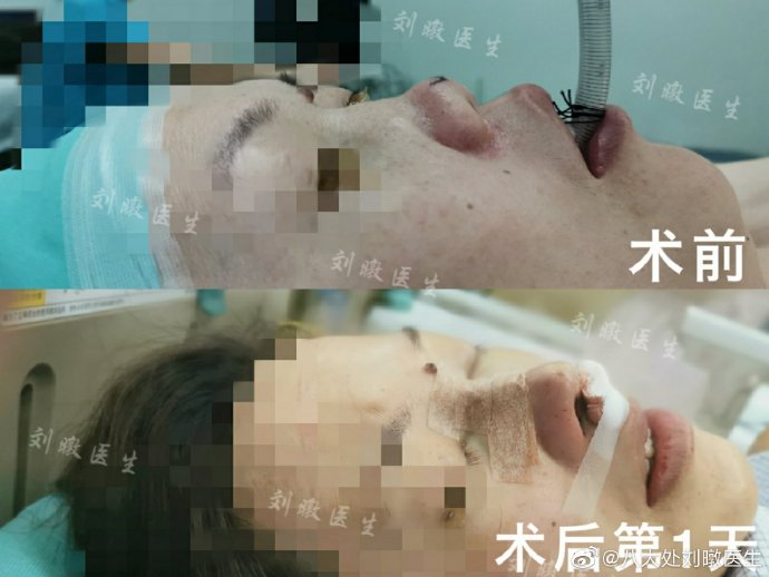 北京八大处隆鼻&鼻修复&鼻部整形最好的专家：刘暾（简介案例预约）怎么样？