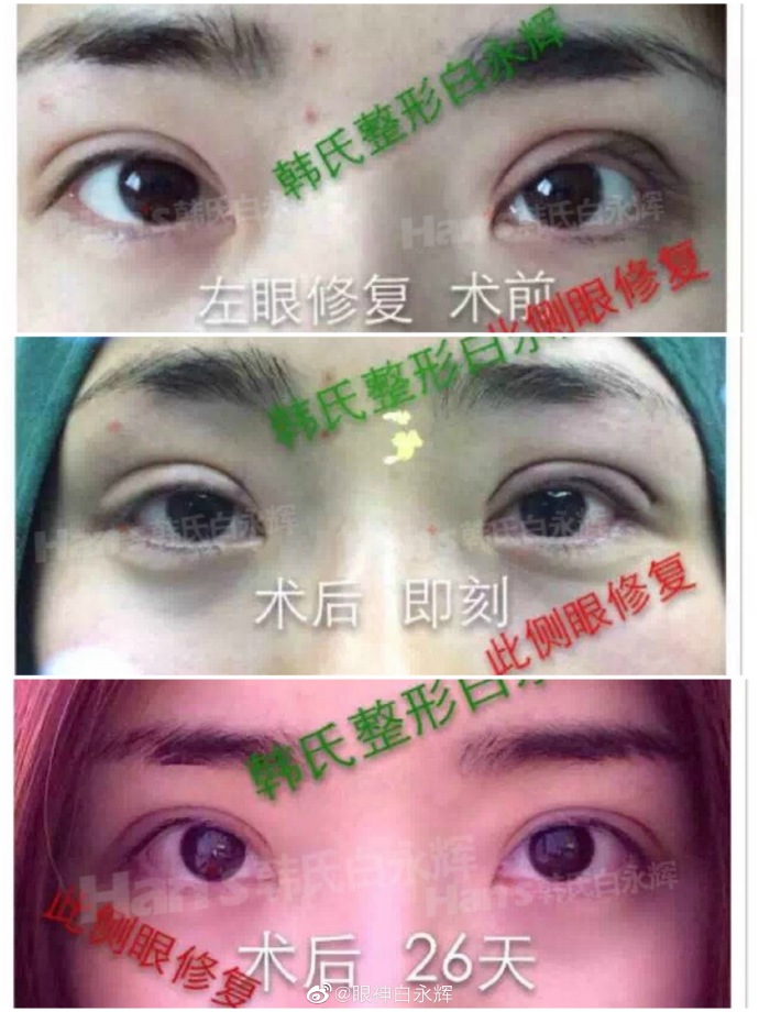 全国最好的双眼皮修复专家：白永辉和高亮修复双眼皮谁更好？