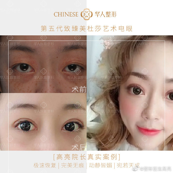 全国最好的双眼皮修复专家：白永辉和高亮修复双眼皮谁更好？