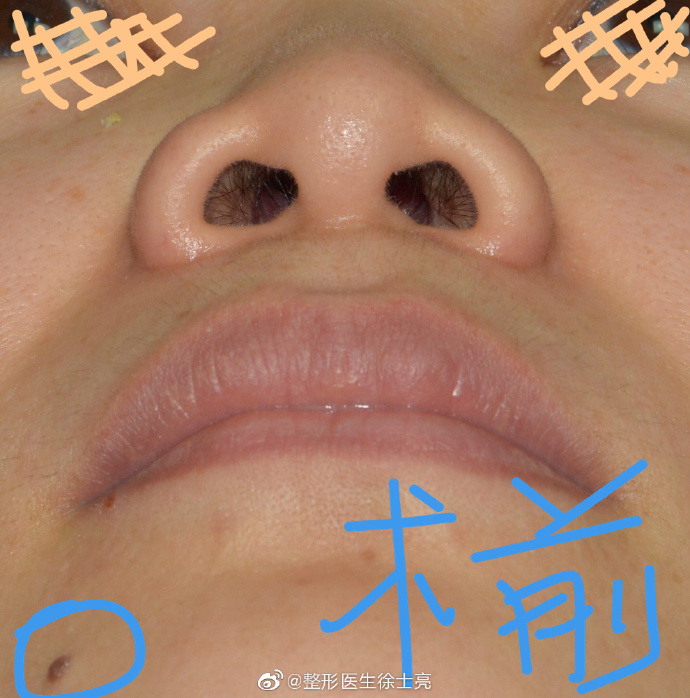 广州最好的隆鼻&鼻修复专家推荐：徐士亮（简介预约案例效果）怎么样？