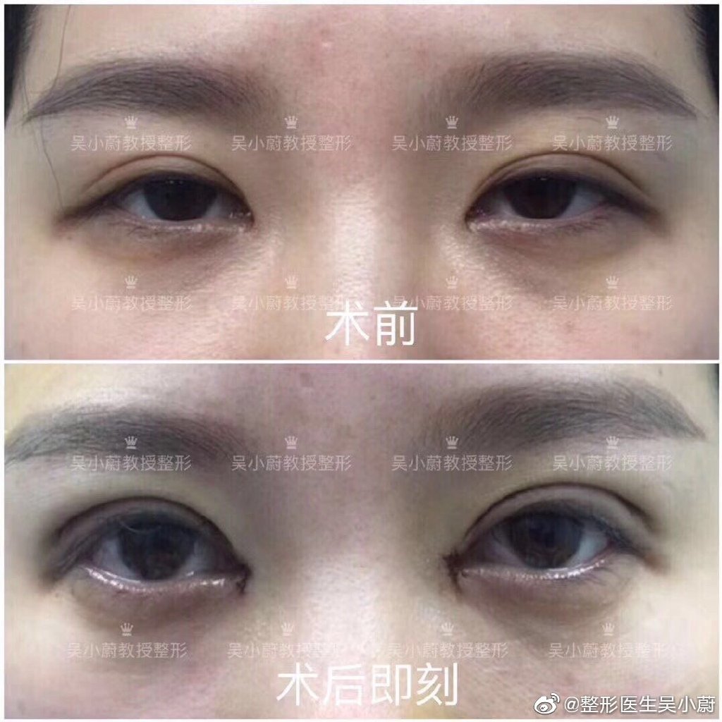 武汉双眼皮修复最好的专家：吴小蔚（案例预约效果）怎么样？