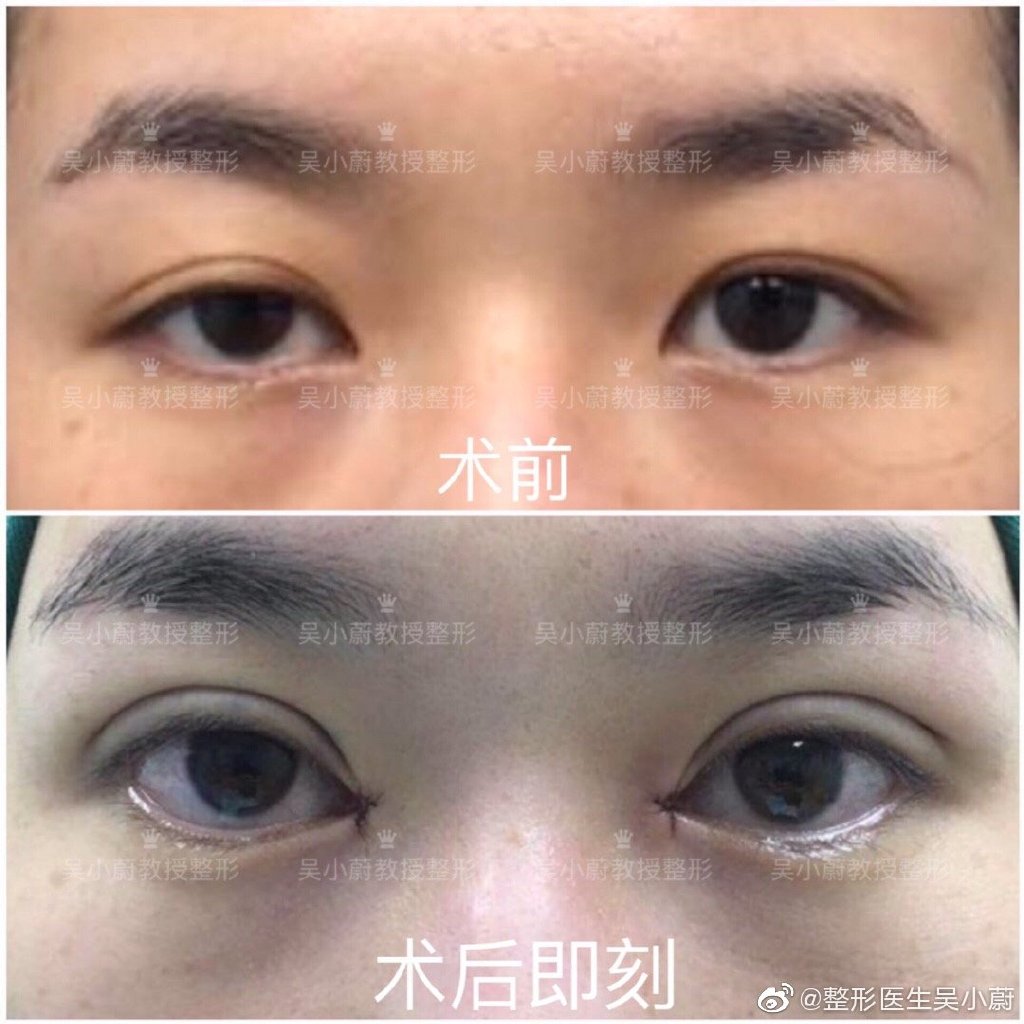 武汉双眼皮修复最好的专家：吴小蔚（案例预约效果）怎么样？