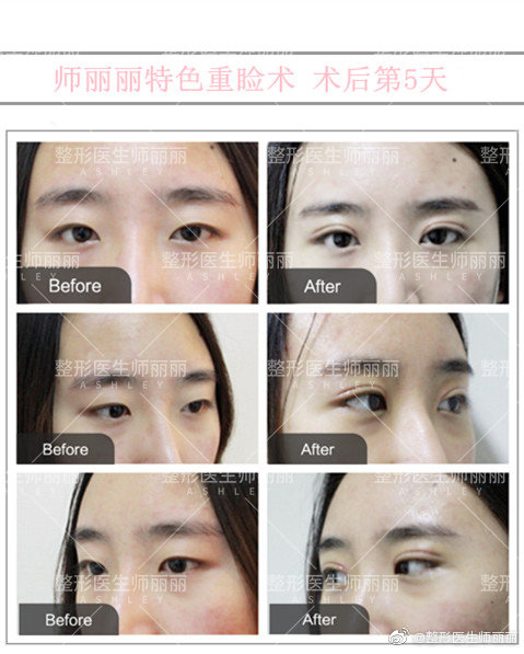 中国眼综合最知名的专家有哪些？师丽丽做眼综合效果好吗？