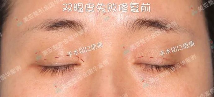 中国最好的眼修复知名专家推荐：金国华（案例预约价格）双眼皮修复怎么样？