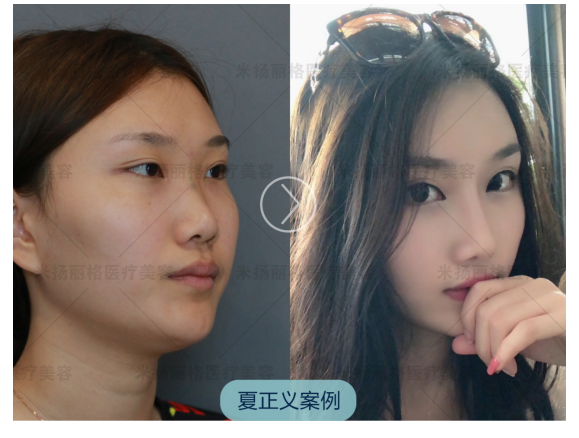 北京鼻部整形&鼻修复整形专家推荐：夏正义（案例效果价格预约）怎么样？