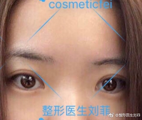 上海九院割双眼皮最好的专家推荐：刘菲（案例预约价格效果）怎么样？