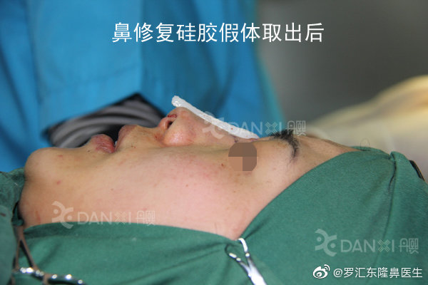 北京擅长做膨体隆鼻或膨体鼻修复的专家有哪些？曾高罗汇东李劲良怎么样？