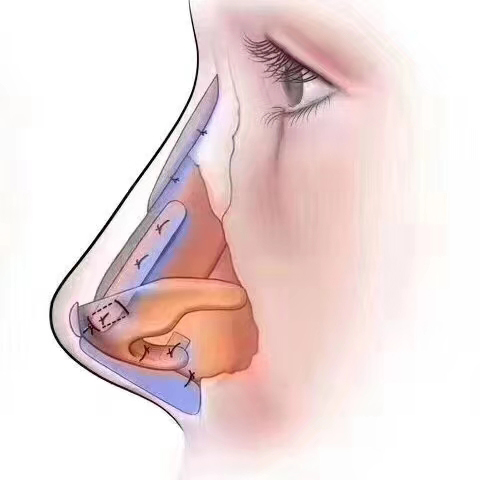 深圳恩吉娜|鼻修复，为何医生都选择肋软骨