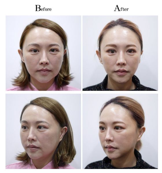 中下脸拉提拉皮合并超音波脸部溶脂真实案例手术前后对比照片图