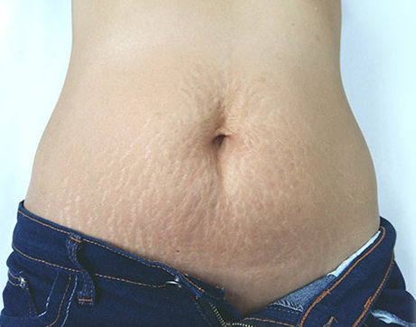 肥胖、腹部松弛(肚皮松垮)及妊娠纹怎么解决？腹部拉皮手术