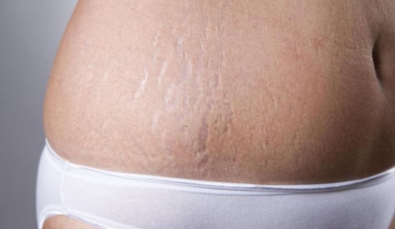产后妊娠纹及妊娠纹疤痕的治疗是怎么样的？