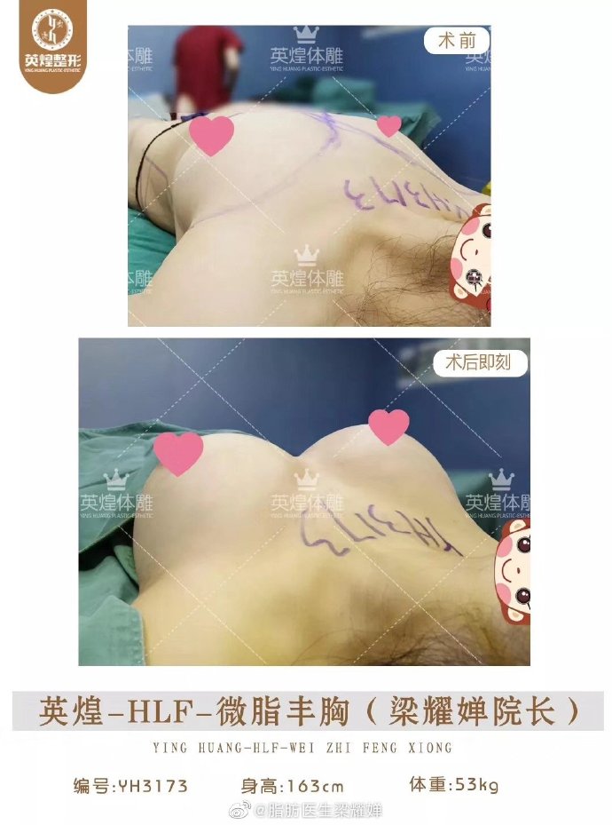 北京王沛森和梁耀婵哪个医生做脂肪丰胸效果好？