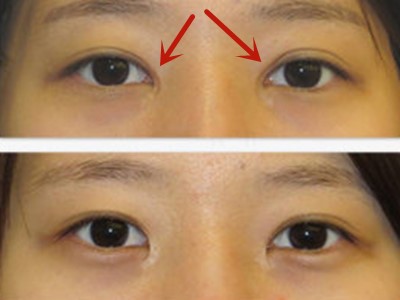 中国最厉害的顶级双眼皮修复专家：曹仁昌和洪星杓（简介案例预约）双眼皮修复谁厉害？