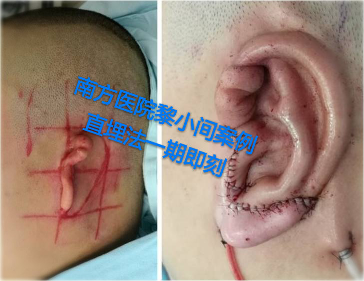 全国耳再造耳畸形最好的专家：广州南方医院黎小间医生耳再造技术到底好不好？