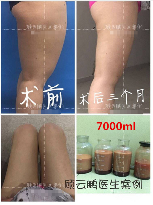 中国最好的大腿吸脂专家：北京八大处顾云鹏大腿吸脂效果好不好？