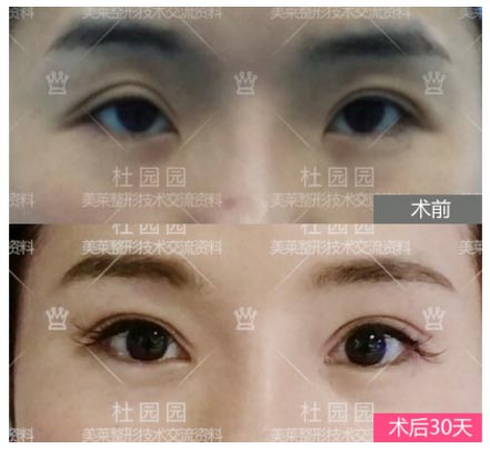 刘风卓和杜园园哪位修复眼睛（双眼皮修复）更好？