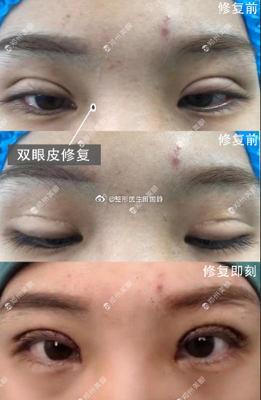 中国最好的顶级双眼皮修复专家：郑州田国静双眼皮修复费用和案例简介