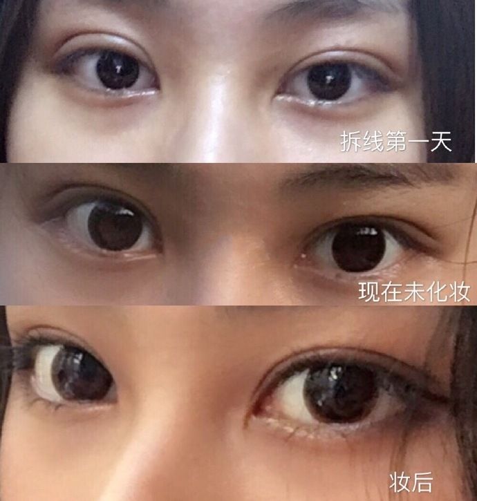最好的眼修复专家推荐：八大处于晓波和上海九院朱惠敏哪个眼修复厉害？