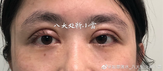 全国最好顶级双眼皮修复专家：北京双眼皮修复王世勇和靳小雷谁厉害？