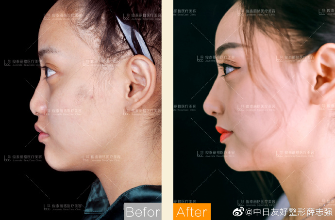 中国顶尖最好的隆鼻专家：北京薛志强跟李劲良哪个做鼻综合效果好？