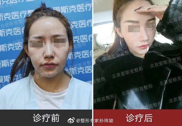 国内最好的面部提升（面部年轻化）专家：北京杨大平和孙玮骏谁的面部提升更好？