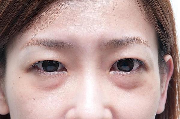 眼袋手术就是拉皮手术？老化的眼袋是什么样的？