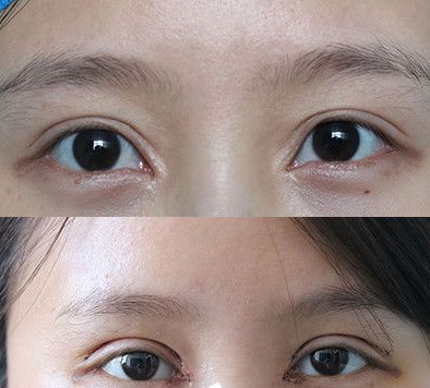 中国做双眼皮眼综合最好的专家：李海东和靳小雷哪个双眼皮做的好？