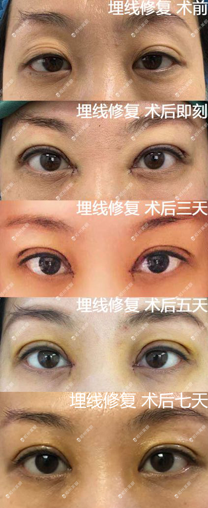 中国最厉害的双眼皮修复专家：刘辅容和田国静哪个眼修复技术厉害？