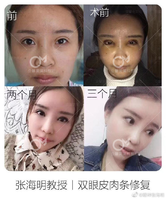 北京眼修复专家王振军与张海明（预约）谁修复双眼皮做的好？
