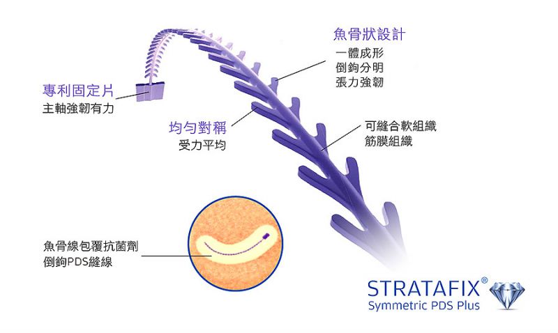 Stratafix蓝钻鱼骨线应用 Stratafix蓝钻鱼骨线疗程的不同处和特点有哪些？
