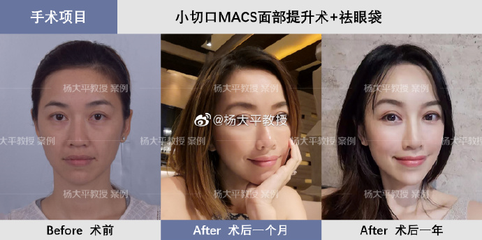 北京面部年轻化专家推荐：面部提升专家杨大平口碑到底怎么样？