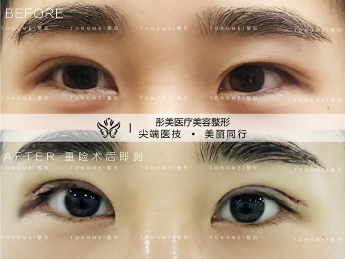 北京双眼皮修复医生：刘风卓白永辉和王世勇（预约）谁修复双眼皮最好呢
