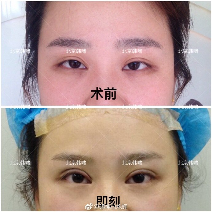 北京双眼皮修复医生：刘风卓白永辉和王世勇（预约）谁修复双眼皮最好呢