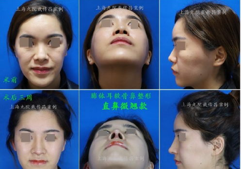 国内做鼻子最厉害的三甲医院医生：戴传昌和刘暾（预约案例）鼻综合哪个好？