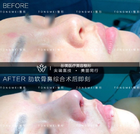 中国顶级知名鼻综合医生：罗汇东李劲良李长赋（预约）哪个医生做鼻综合好？