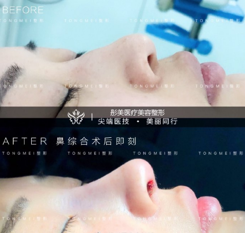中国顶级知名鼻综合医生：罗汇东李劲良李长赋（预约）哪个医生做鼻综合好？